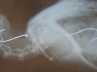 X-Ray of Black faced cormorant with two hooks